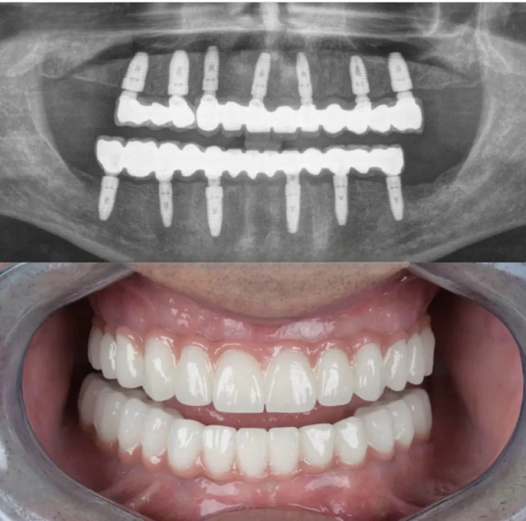 Çift çene implant köprü - röntgen ve son gülüş