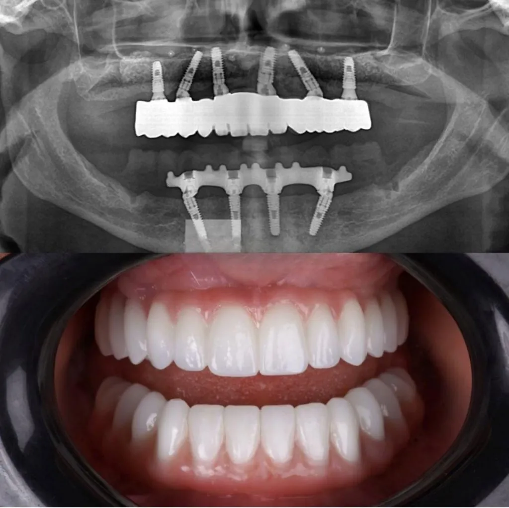Hollywood Smile