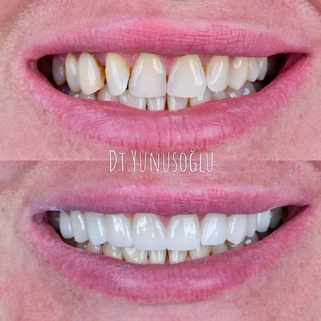 Close-up before and after: worn and stained upper teeth restored to a uniform white smile