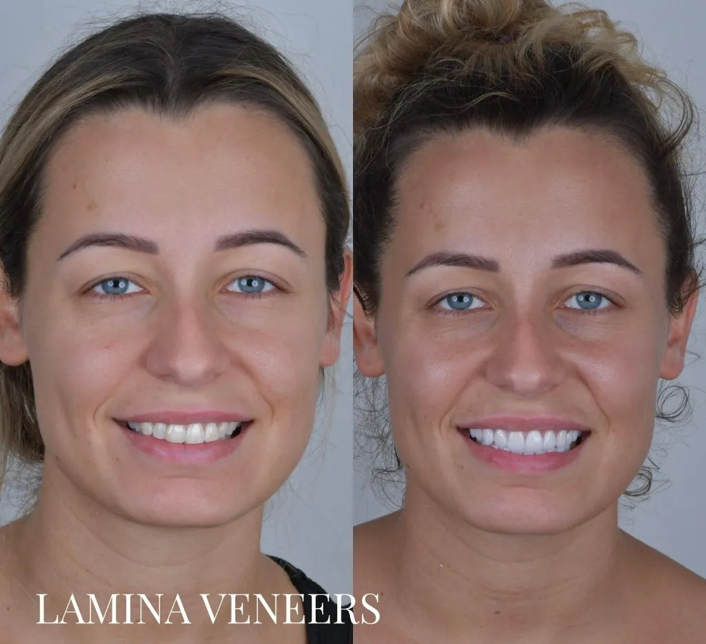 Female patient before and after laminate veneers: a brighter, fuller smile