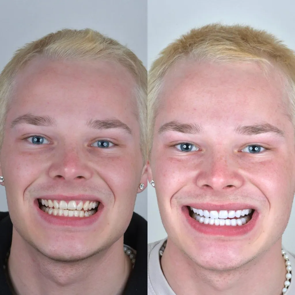 Young male patient before and after treatment: yellowish teeth transformed into a bright white smile