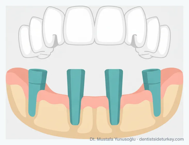 All-on-4 layout: four titanium implants, two upright at the front and two angled at the back, supporting a full-arch bridge