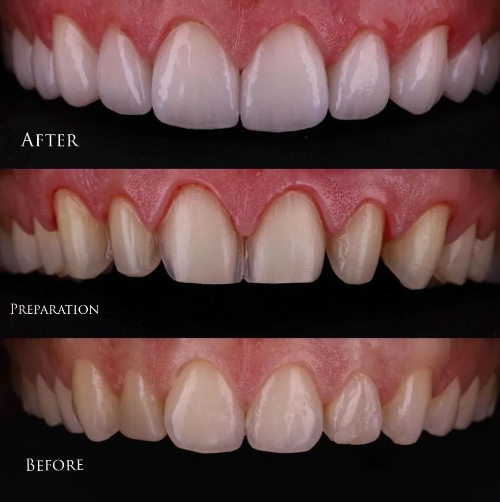 Three stages of veneer treatment: original teeth, minimal preparation, and the final result