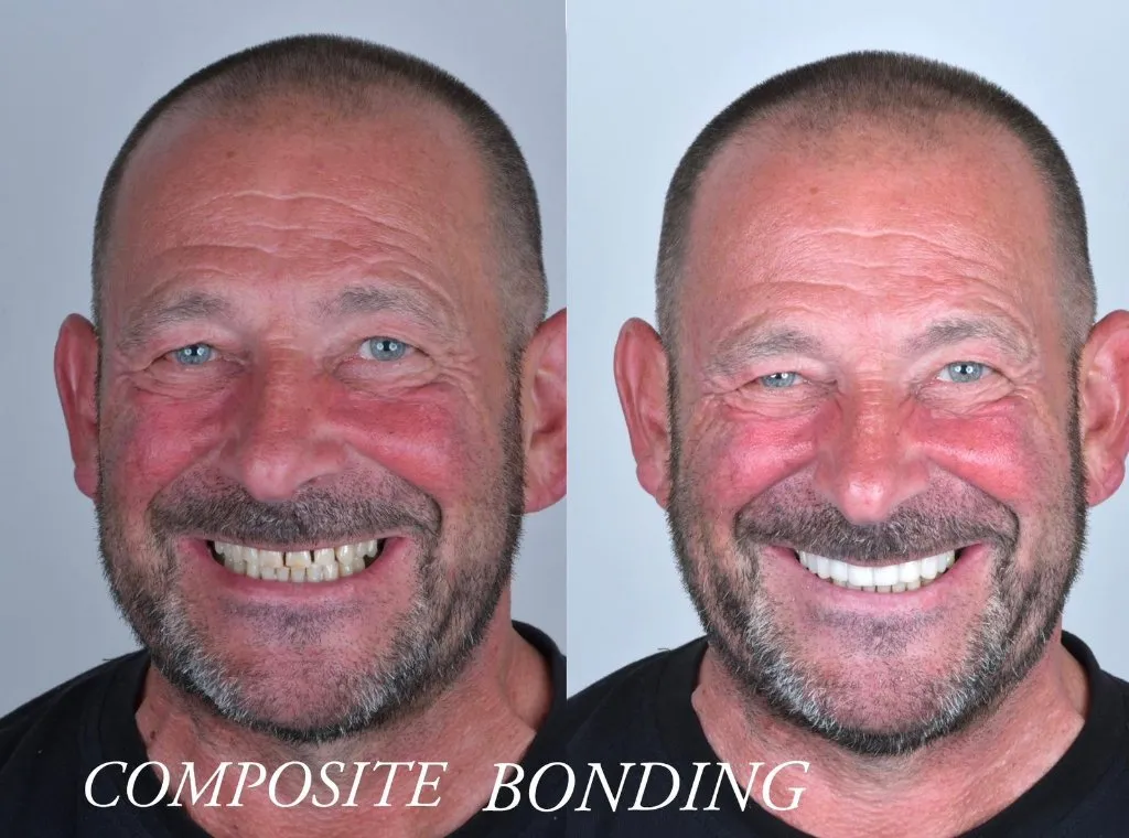 Kompozit bonding - öncesi ve sonrası