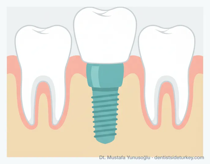 Cross-section of a dental implant: titanium screw in the jawbone, abutment through the gum, porcelain crown on top