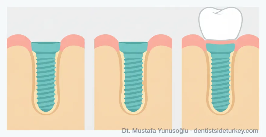 Three stages of osseointegration: implant placed in the jawbone, bone growing against the titanium, bone fully fused with the crown fitted