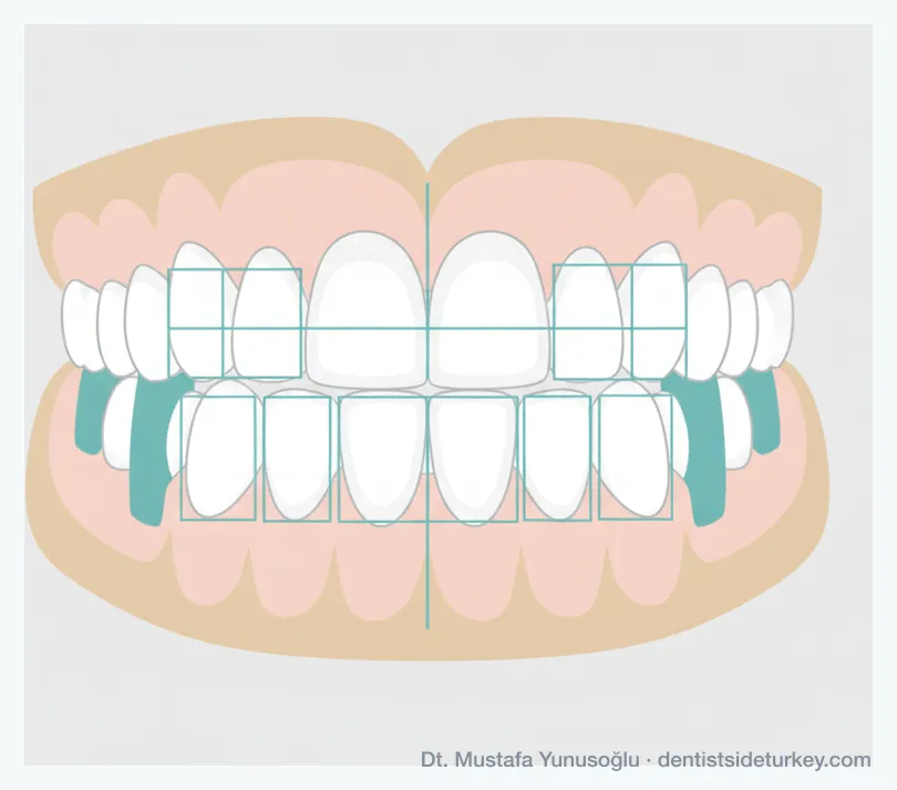 Smile design proportion guides over an upper dental arch, showing the facial midline and the width ratio of each front tooth
