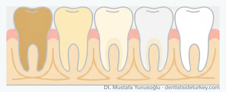 Teeth whitening shade progression from a dark yellowish tone through four steps to a bright white shade